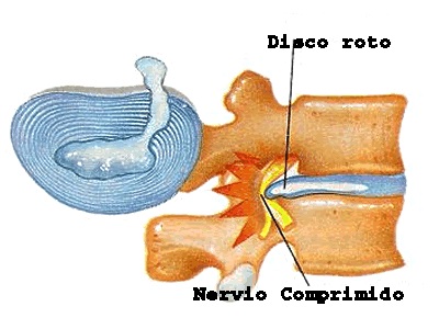 Dormir con hernia discal